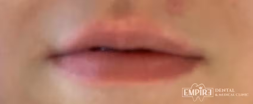 Before non-surgical facial aesthetics at Empire Clinic Dublin 1 — case 24