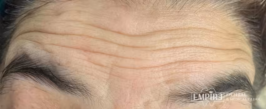 Before non-surgical facial aesthetics at Empire Clinic Dublin 1 — case 23