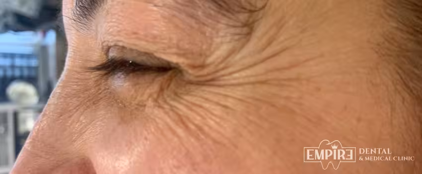 Before non-surgical facial aesthetics at Empire Clinic Dublin 1 — case 22