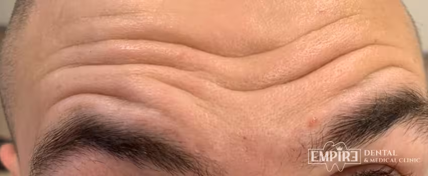 Before non-surgical facial aesthetics at Empire Clinic Dublin 1 — case 20
