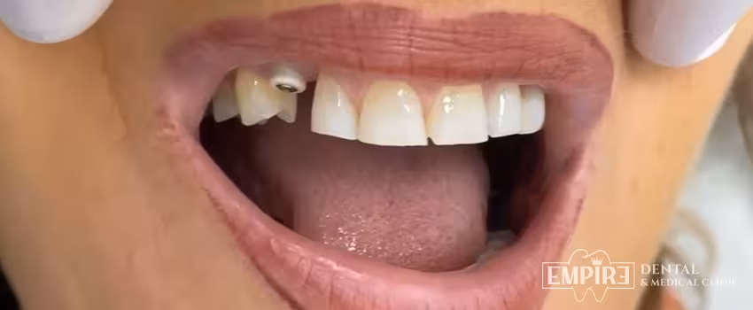 Before dental treatment at Empire Dental Clinic Dublin 1 — case 27