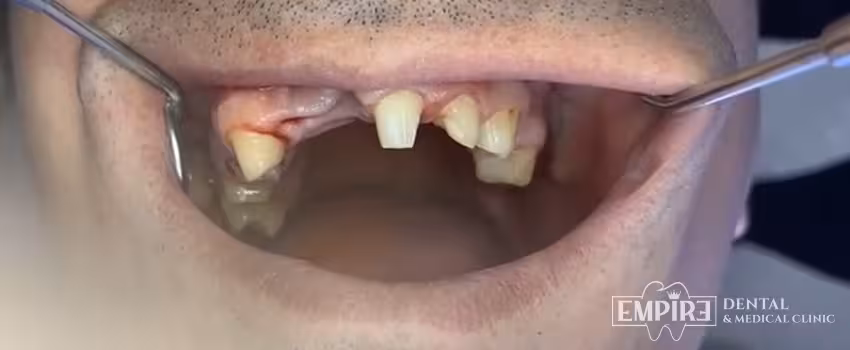 Before dental treatment at Empire Dental Clinic Dublin 1 — case 28