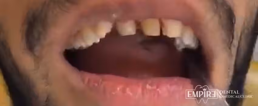 Before dental treatment at Empire Dental Clinic Dublin 1 — case 26