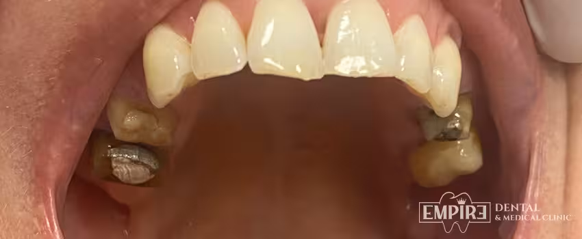 Before dental treatment at Empire Dental Clinic Dublin 1 — case 25
