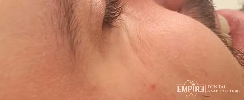 After non-surgical facial aesthetics result at Empire Clinic Dublin 1 — case 30