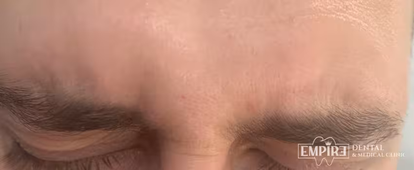 After non-surgical facial aesthetics result at Empire Clinic Dublin 1 — case 31