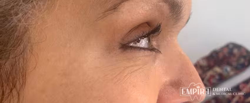 After non-surgical facial aesthetics result at Empire Clinic Dublin 1 — case 39