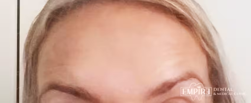After non-surgical facial aesthetics result at Empire Clinic Dublin 1 — case 33