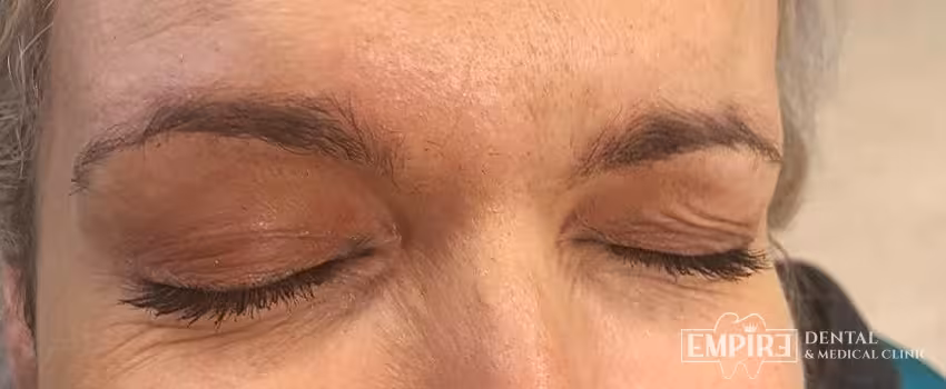After non-surgical facial aesthetics result at Empire Clinic Dublin 1 — case 34