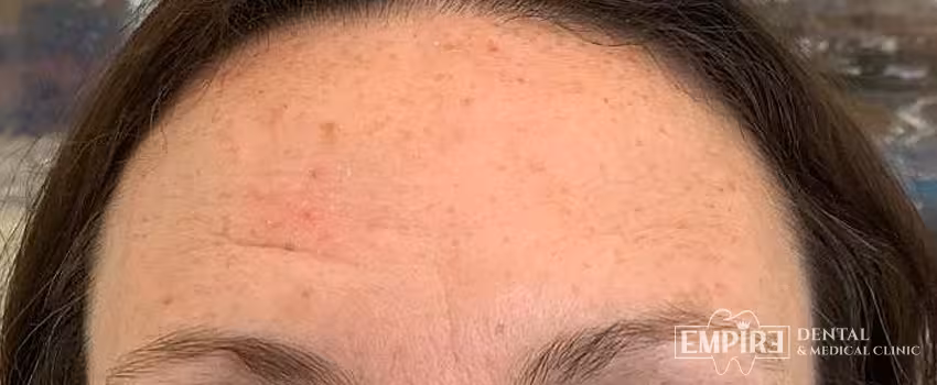 After non-surgical facial aesthetics result at Empire Clinic Dublin 1 — case 35