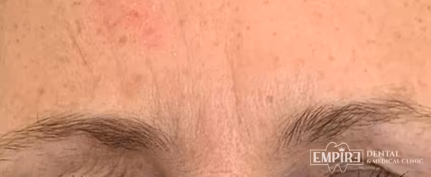 After non-surgical facial aesthetics result at Empire Clinic Dublin 1 — case 36