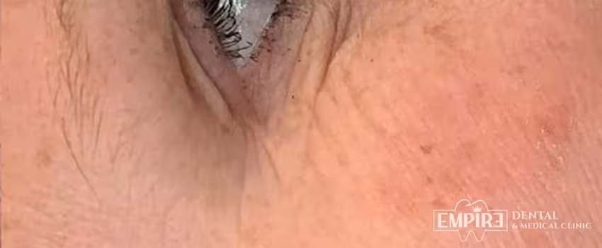 After non-surgical facial aesthetics result at Empire Clinic Dublin 1 — case 37