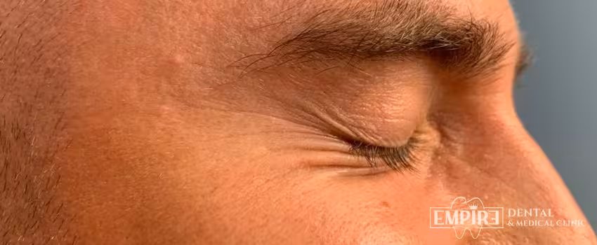 After non-surgical facial aesthetics result at Empire Clinic Dublin 1 — case 38