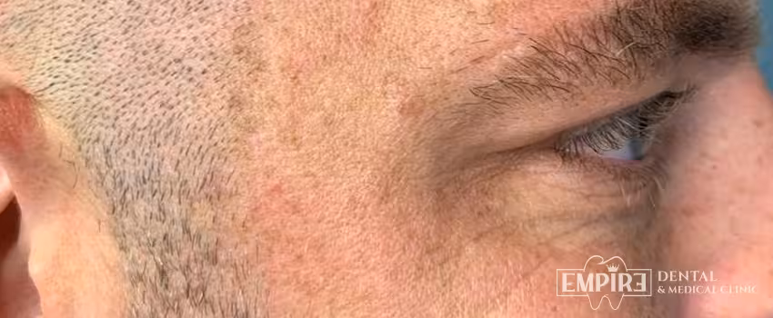 After non-surgical facial aesthetics result at Empire Clinic Dublin 1 — case 32