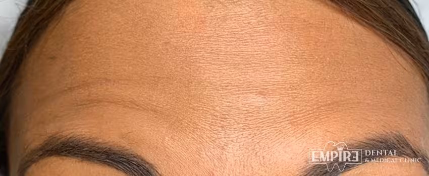 After non-surgical facial aesthetics result at Empire Clinic Dublin 1 — case 40