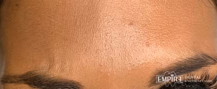 After non-surgical facial aesthetics result at Empire Clinic Dublin 1 — case 42