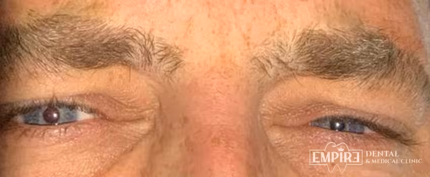 After non-surgical facial aesthetics result at Empire Clinic Dublin 1 — case 50