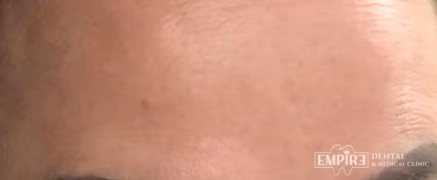 After non-surgical facial aesthetics result at Empire Clinic Dublin 1 — case 49