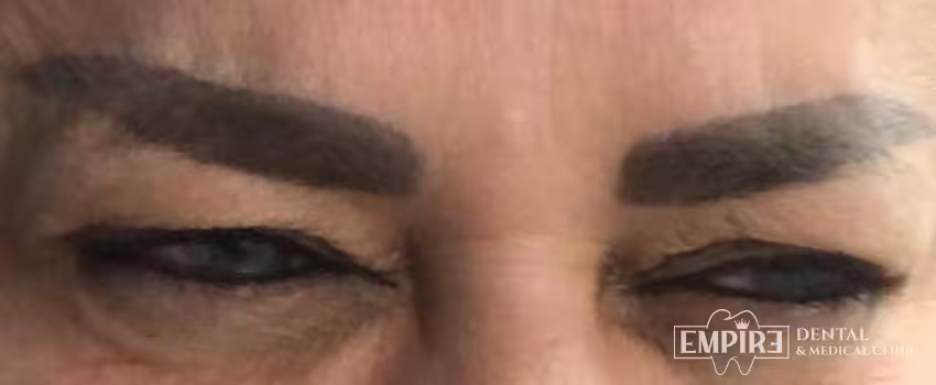 After non-surgical facial aesthetics result at Empire Clinic Dublin 1 — case 48