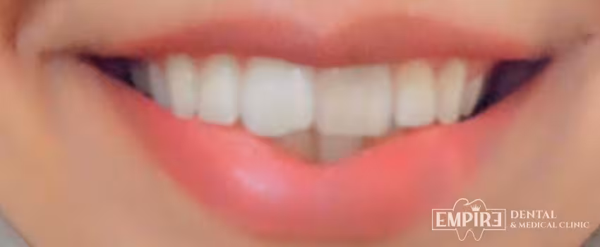 After non-surgical facial aesthetics result at Empire Clinic Dublin 1 — case 46