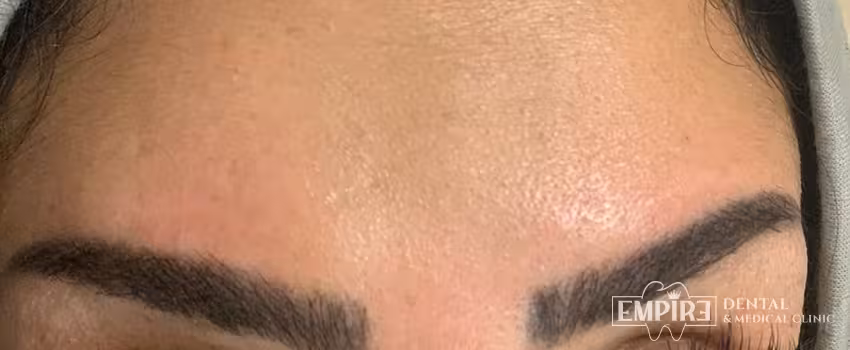 After non-surgical facial aesthetics result at Empire Clinic Dublin 1 — case 45