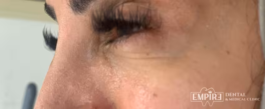 After non-surgical facial aesthetics result at Empire Clinic Dublin 1 — case 44