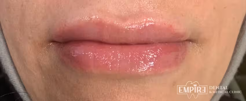 After non-surgical facial aesthetics result at Empire Clinic Dublin 1 — case 43