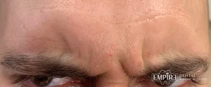 Before non-surgical facial aesthetics at Empire Clinic Dublin 1 — case 31