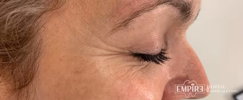 Before non-surgical facial aesthetics at Empire Clinic Dublin 1 — case 39