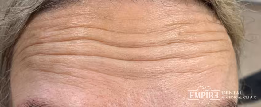 Before non-surgical facial aesthetics at Empire Clinic Dublin 1 — case 33