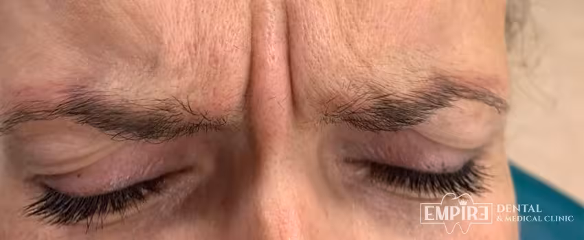 Before non-surgical facial aesthetics at Empire Clinic Dublin 1 — case 34