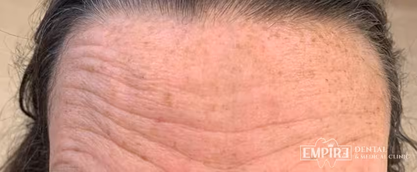 Before non-surgical facial aesthetics at Empire Clinic Dublin 1 — case 35