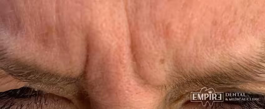 Before non-surgical facial aesthetics at Empire Clinic Dublin 1 — case 36