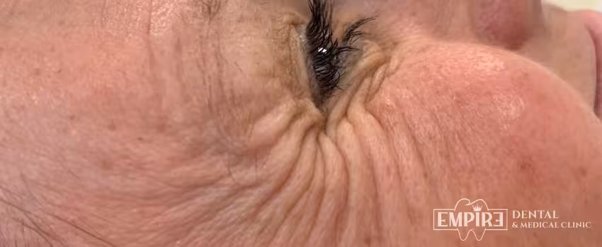 Before non-surgical facial aesthetics at Empire Clinic Dublin 1 — case 37