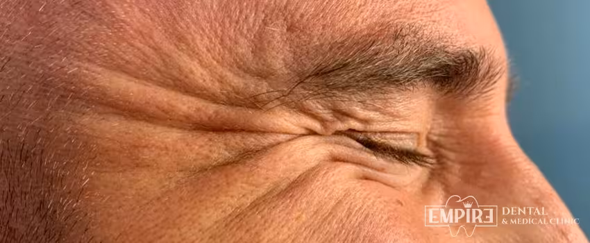 Before non-surgical facial aesthetics at Empire Clinic Dublin 1 — case 38