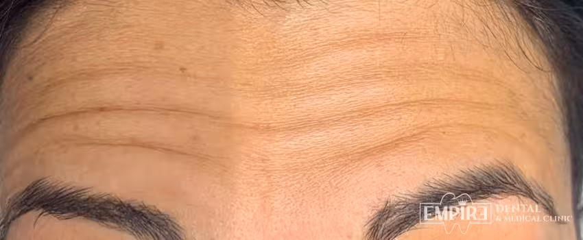 Before non-surgical facial aesthetics at Empire Clinic Dublin 1 — case 40