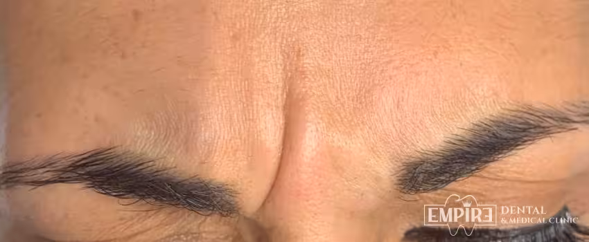 Before non-surgical facial aesthetics at Empire Clinic Dublin 1 — case 42
