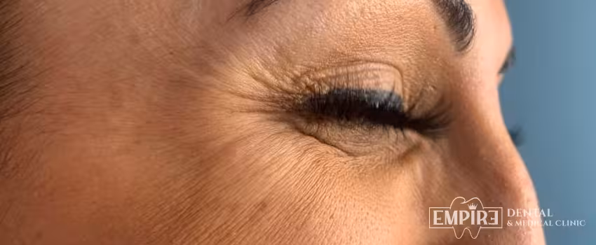 Before non-surgical facial aesthetics at Empire Clinic Dublin 1 — case 41