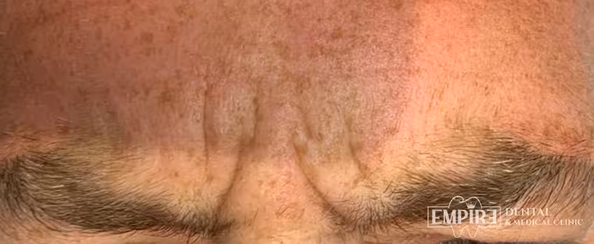 Before non-surgical facial aesthetics at Empire Clinic Dublin 1 — case 50
