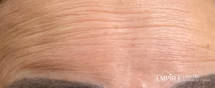 Before non-surgical facial aesthetics at Empire Clinic Dublin 1 — case 49