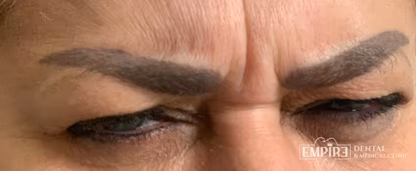 Before non-surgical facial aesthetics at Empire Clinic Dublin 1 — case 48