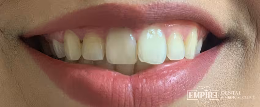Before non-surgical facial aesthetics at Empire Clinic Dublin 1 — case 46