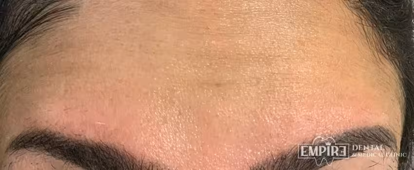 Before non-surgical facial aesthetics at Empire Clinic Dublin 1 — case 45