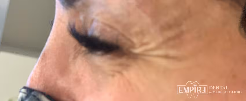 Before non-surgical facial aesthetics at Empire Clinic Dublin 1 — case 44