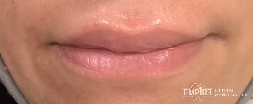 Before non-surgical facial aesthetics at Empire Clinic Dublin 1 — case 43