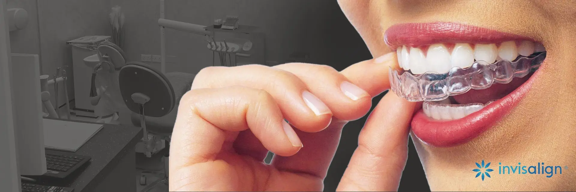 Invisalign Invisible Aligners