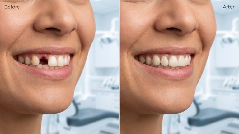 Before and After